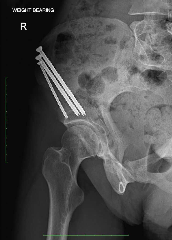 Right PAO Periacetabular Osteotomy
