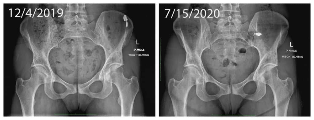 Pubic debridement adhesive capsulitis of the hips