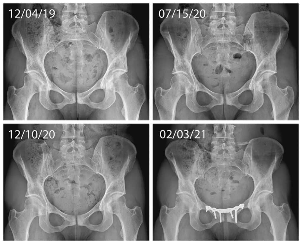 Pubic Joint Fusion osteitis pubis pubic debridement