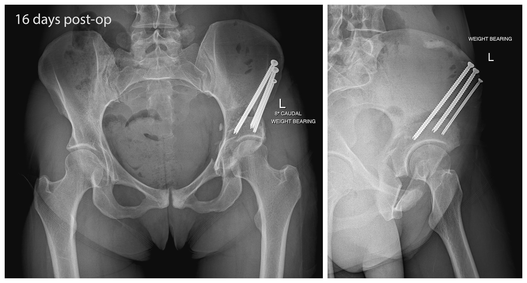 Left PAO Periacetabular Osteotomy